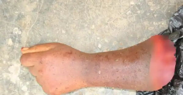 Jealous man chops off ex-girlfriend’s hand in Ghana (Photo)